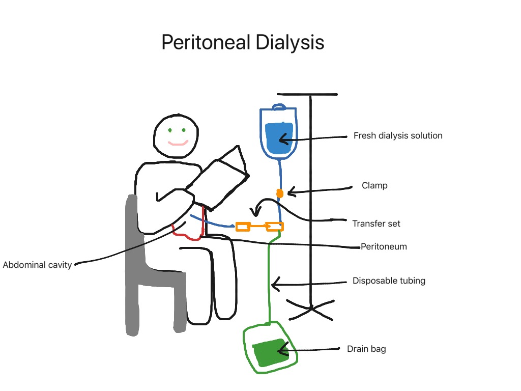 Peritoneal dialysis | Science, Human-body, Medical, Nursing ...