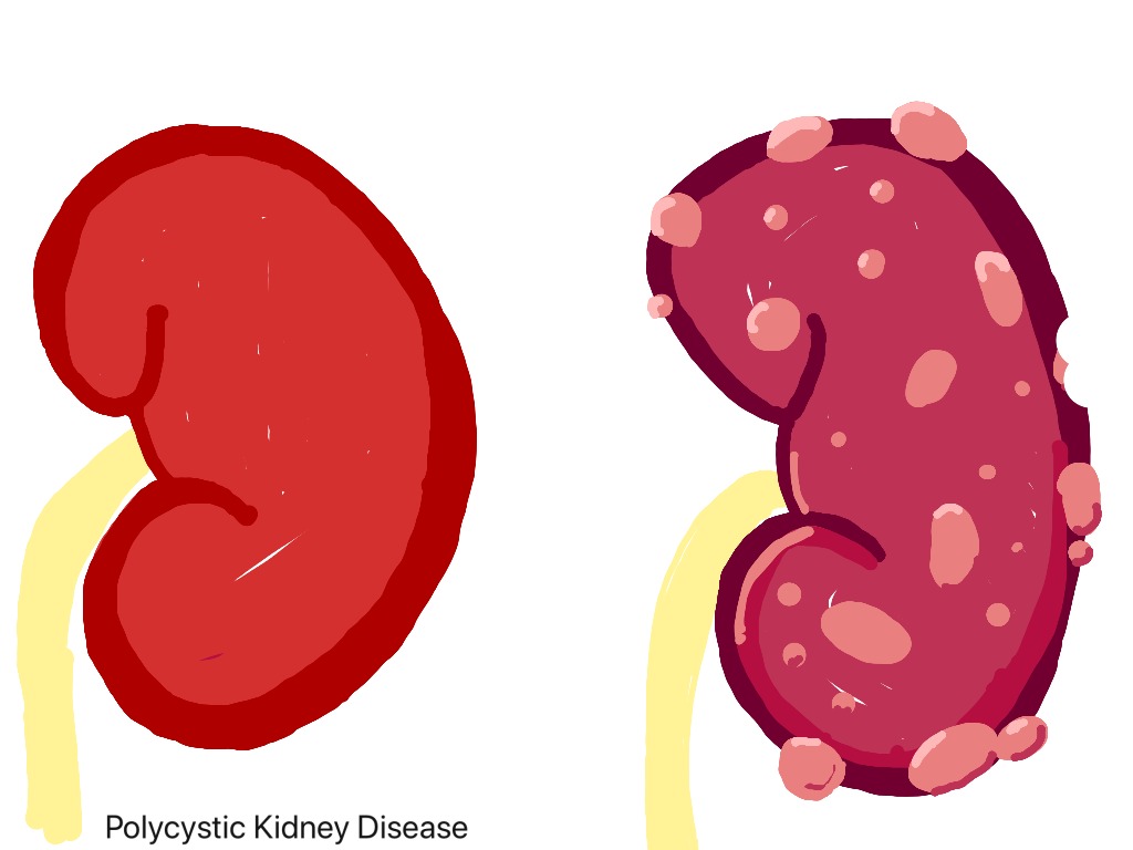 Polycystic Kidney Disease | Science, Human-body, Medical | ShowMe